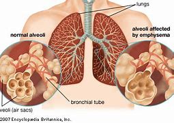 Image result for Chronic Emphysema