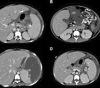 Image result for Spleen Enlargement CT