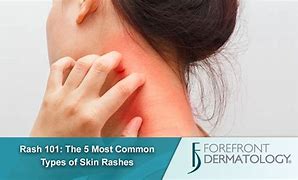 Image result for Diagnose Skin Rash