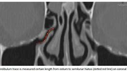 Image result for Infundibulum Nose