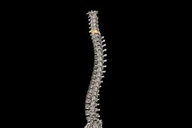 Image result for C6 Spinal