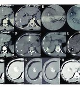 Image result for Tace Ablation