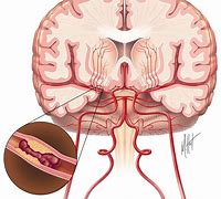 Image result for Acute Stroke