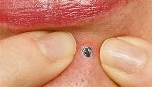 Image result for Pop Pimple Popping