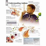 Image result for Symptoms of Asthma