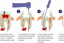 Image result for Root Canal Darkening