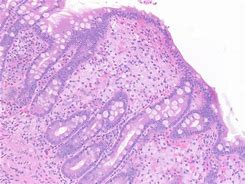 Image result for Whipple Specimen Gross Pathology