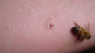 Image result for Honey Bee Sting