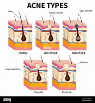 Image result for Papule Pimple