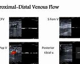 Image result for Nonphasic Venous Flow