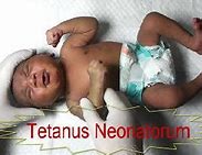 Image result for Tetanus Neonatorum