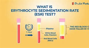 Image result for ESR Procedure