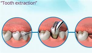 Image result for Complex Tooth Extraction