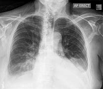 Image result for Pleural Effusion Images