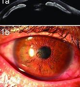 Image result for Corneal Perforation