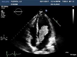 Image result for Cardiac Myxoma