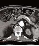 Image result for Spleen Metastasis