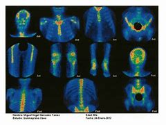 Image result for Hemangioma Tumor