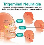 Image result for Atypical Trigeminal Neuralgia