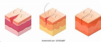 Image result for Wrist Laceration