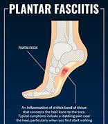 Image result for Plantarfasziitis