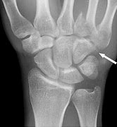 Image result for hamate bone x-ray