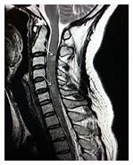 Image result for Abnormal Thoracic Spine MRI