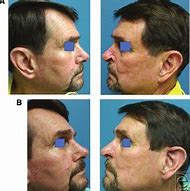 Image result for Nasal Alar Groove