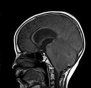 Image result for Medulloblastoma Location Diagram