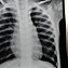 Image result for Asthma Chest X-Ray