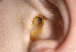 Image result for Yeast Infection in Ear Canal