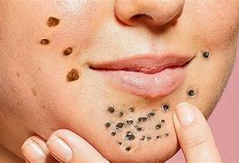 Image result for Skin Peels Blackhead Removal