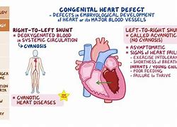 Image result for Cyanotic Heart Defect