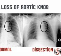 Image result for Aortic Rupture CXR