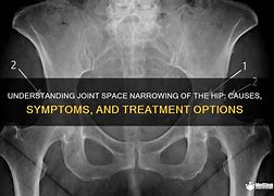 Image result for Hip Joint Space Narrowing