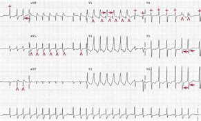 Image result for SVT vs Rapid AFib