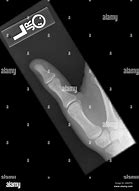 Image result for Thumb X-ray Child