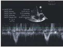 Image result for Continuous Wave Doppler Ultrasound