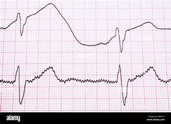 Image result for Heart Failure Electrocardiogram