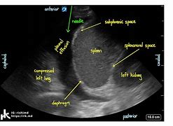 Image result for Pleural Effusion Images