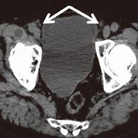 Image result for Distended Bladder