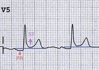 Image result for Pericarditis EKG Findings Example