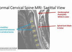 Image result for C-spine MRI