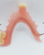 Image result for Metal-Based Partial Dentures