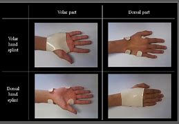 Image result for Volar and Dorsal Hand