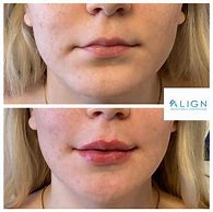 Image result for Versa Lip Filler