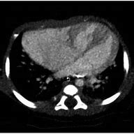 Image result for Right Atrial Appendage Aneurysm