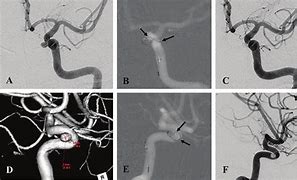 Image result for ICA Aneurysm