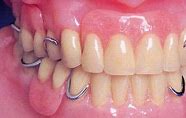 Image result for Partial Denture Clasps