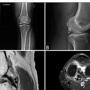 Image result for Posterior Knee Loose Bodies